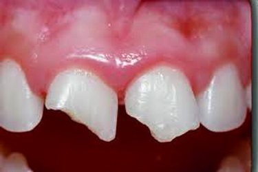 Teeth whitening laser bedfordshire