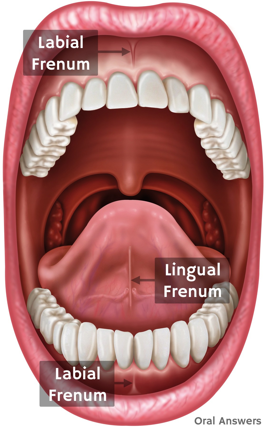 Frenectomy Treatments From Cambridge Dentist