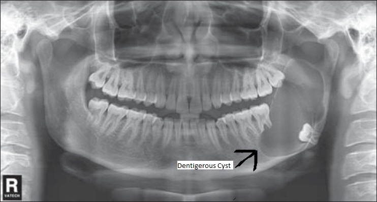 Teeth whitening with laser
