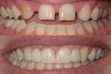 Dental Bridge Treatments At The Cambridge Dental Hub